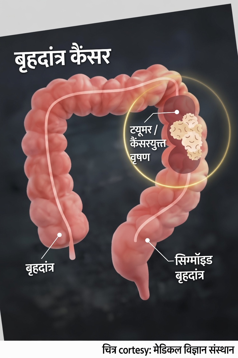 कोलन कैंसर के 5 सामान्य संकेत और लक्षण जिनके बारे में आपको अपने स्वास्थ्य सेवा प्रदाता से चर्चा करनी चाहिए