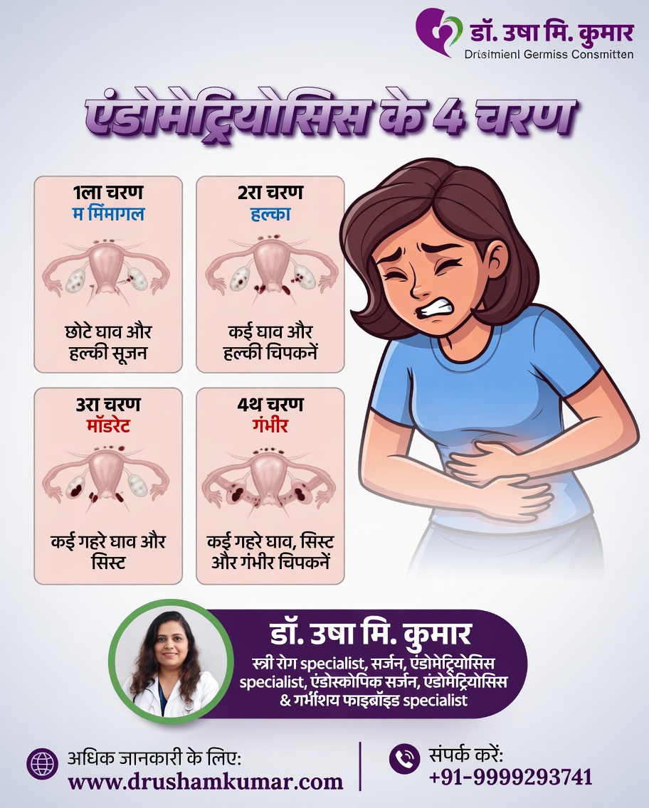 एंडोमेट्रियोसिस के बारे में हर महिला को क्या जानना चाहिए