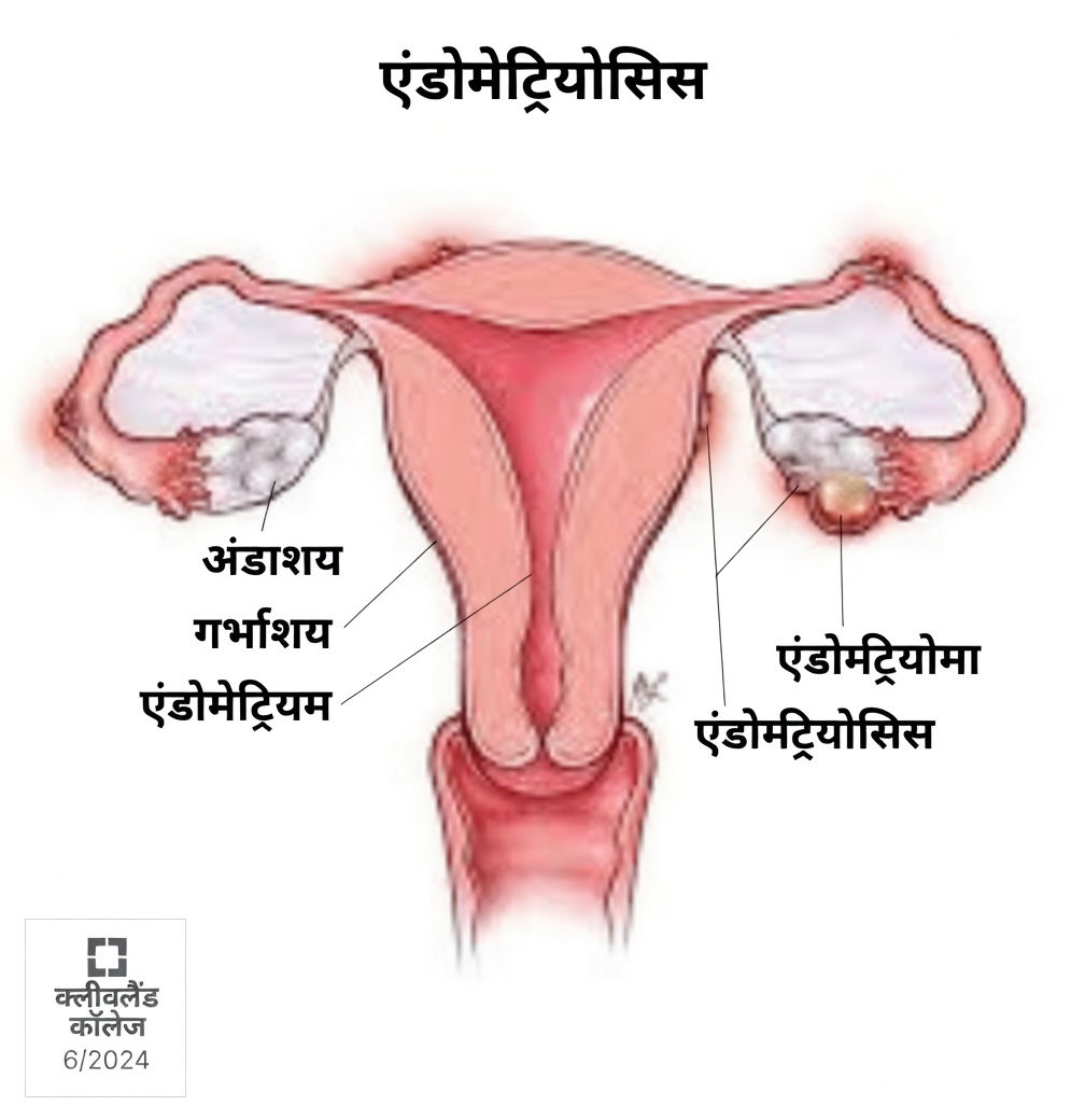 एंडोमेट्रियोसिस क्या है और हर महिला को इसके बारे में क्यों जानना चाहिए?