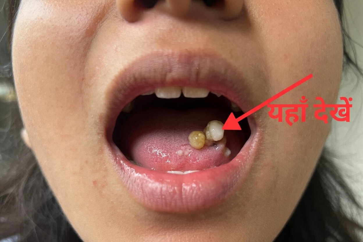 टॉन्सिल स्टोन्स: वह सब कुछ जो आपको जानना चाहिए