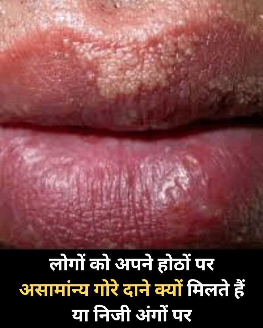 लोग अपने होंठों या निजी अंगों पर असामान्य छोटे सफेद दाने क्यों देखते हैं: एक सरल मार्गदर्शिका