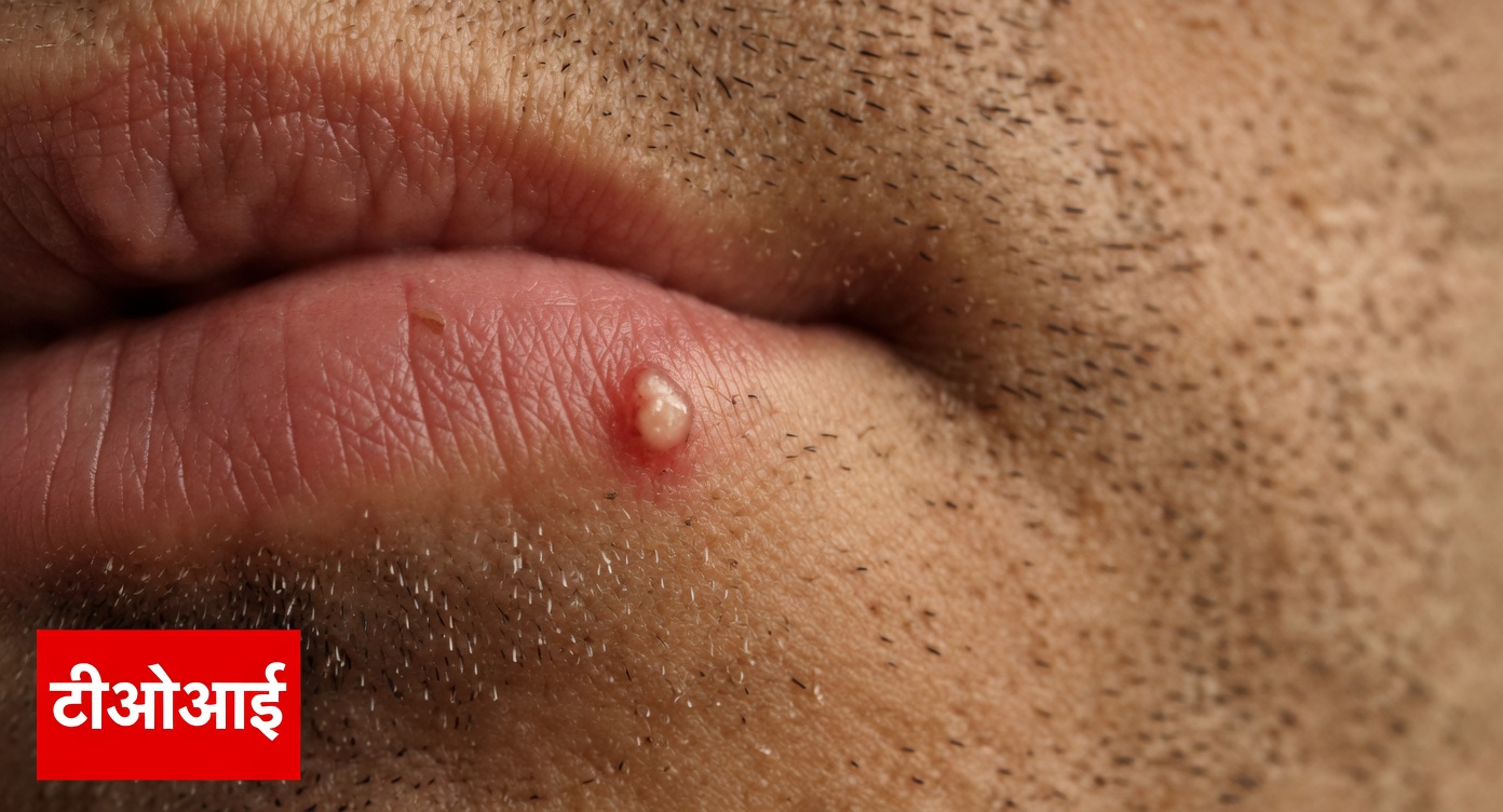लोग अपने होंठों या निजी अंगों पर असामान्य छोटे सफेद दाने क्यों देखते हैं: एक सरल मार्गदर्शिका