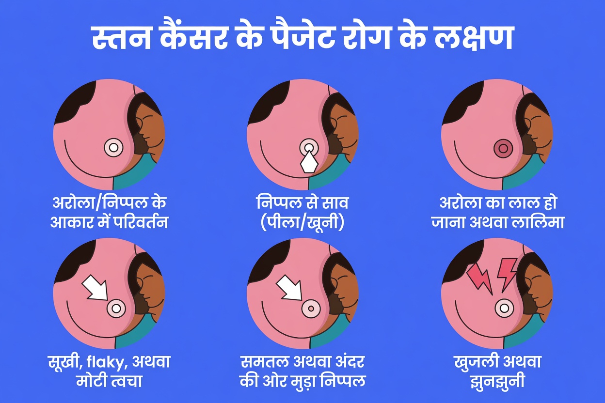 क्या आप स्तन कैंसर के इन शुरुआती चेतावनी संकेतों को नज़रअंदाज़ कर रही हैं? हर महिला को क्या जानना चाहिए