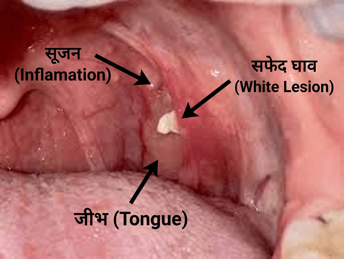 छींकने के बाद आपके गले से निकली वह छोटी गांठ क्या है? टॉन्सिल स्टोन को समझें