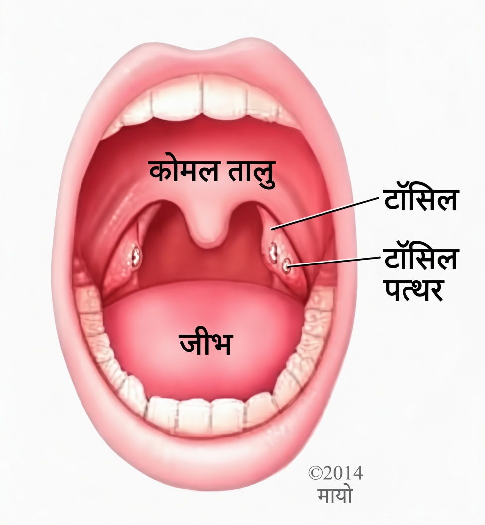 छींकने के बाद आपके गले से निकली वह छोटी गांठ क्या है? टॉन्सिल स्टोन को समझें