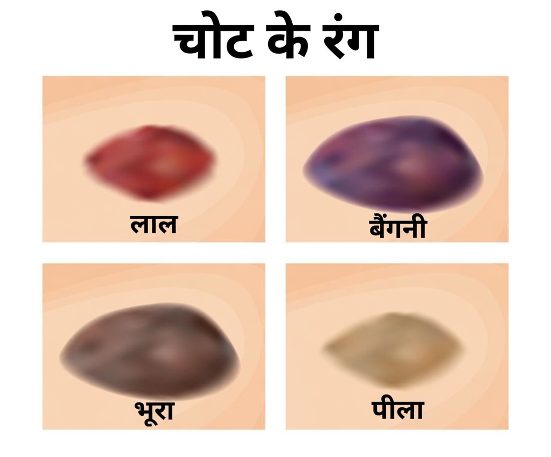 आपके नीले निशान का रंग क्या बताता है? यह आपके शरीर की ओर से भेजी जा रही एक चेतावनी हो सकती है