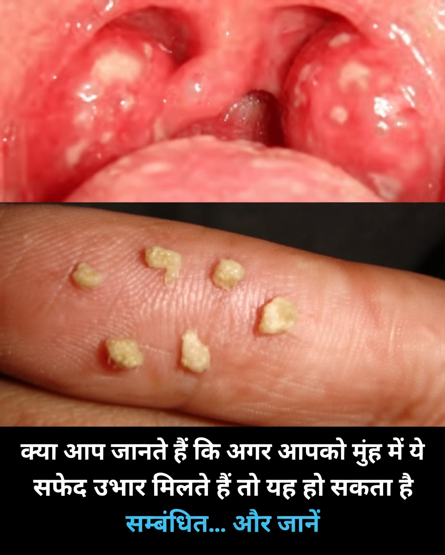 जानें, आपके मुंह में दिखाई देने वाले वे सफेद उभार क्या संकेत दे सकते हैं और कौन-सी दैनिक आदतें अपनाना फायदेमंद हो सकती हैं