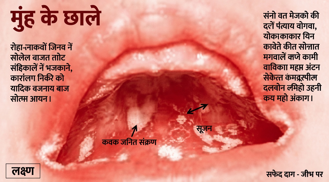 जानें, आपके मुंह में दिखाई देने वाले वे सफेद उभार क्या संकेत दे सकते हैं और कौन-सी दैनिक आदतें अपनाना फायदेमंद हो सकती हैं