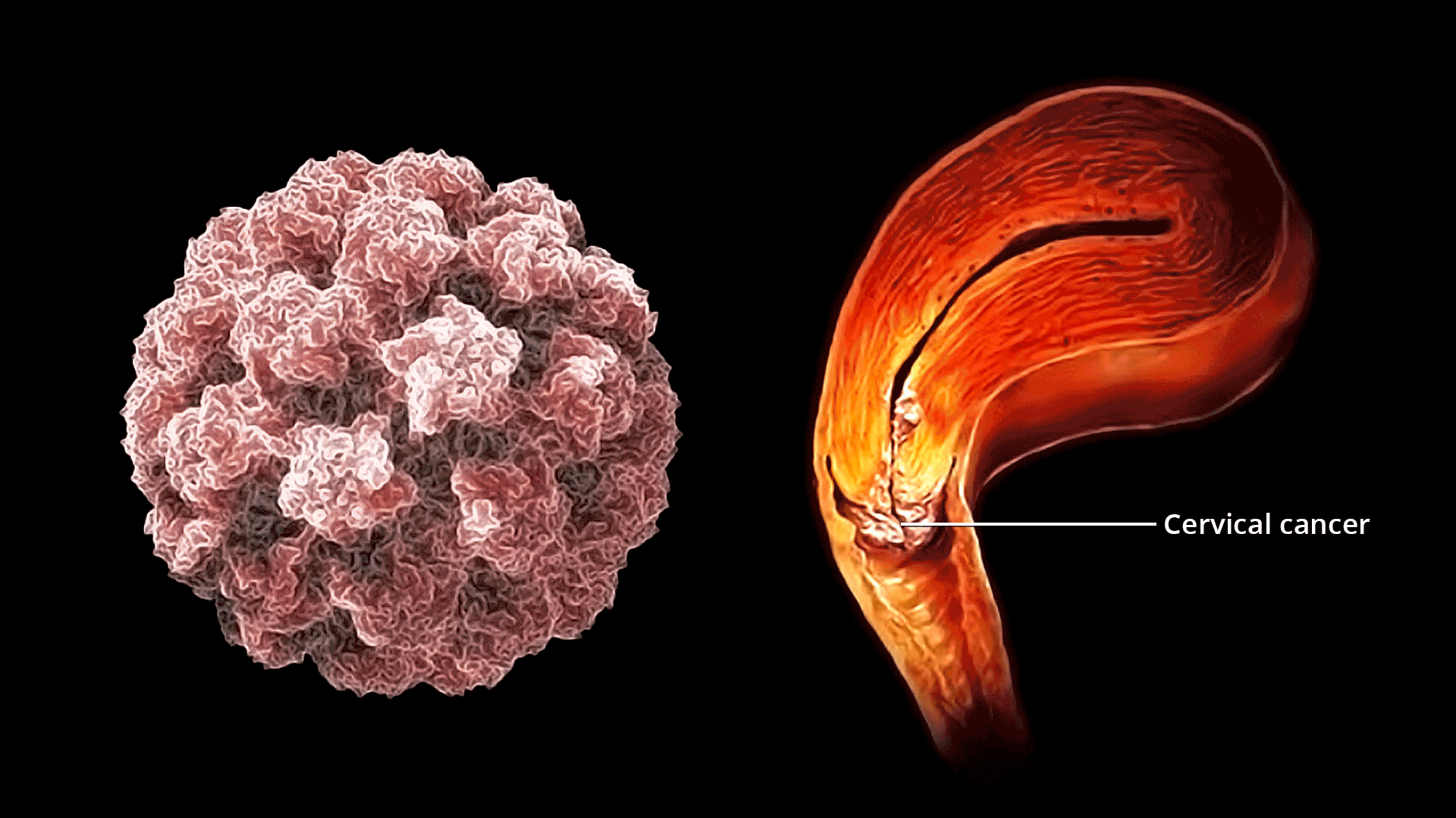 सर्वाइकल कैंसर के गंभीर लक्षण जिन्हें हर महिला को जानना चाहिए और कभी नज़रअंदाज़ नहीं करना चाहिए