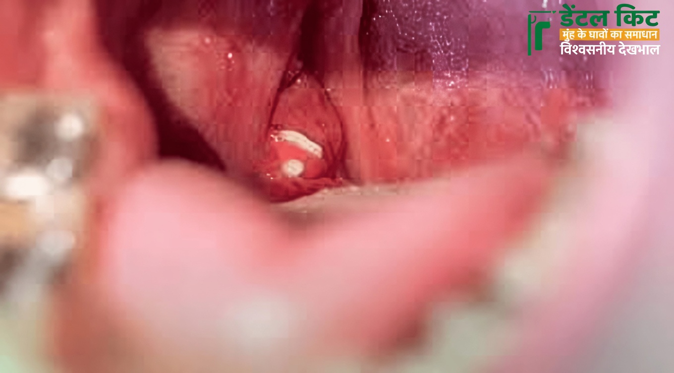 टॉन्सिल स्टोन्स: ये क्या हैं और आपकी लगातार रहने वाली बदबूदार सांस के पीछे ये क्यों हो सकते हैं