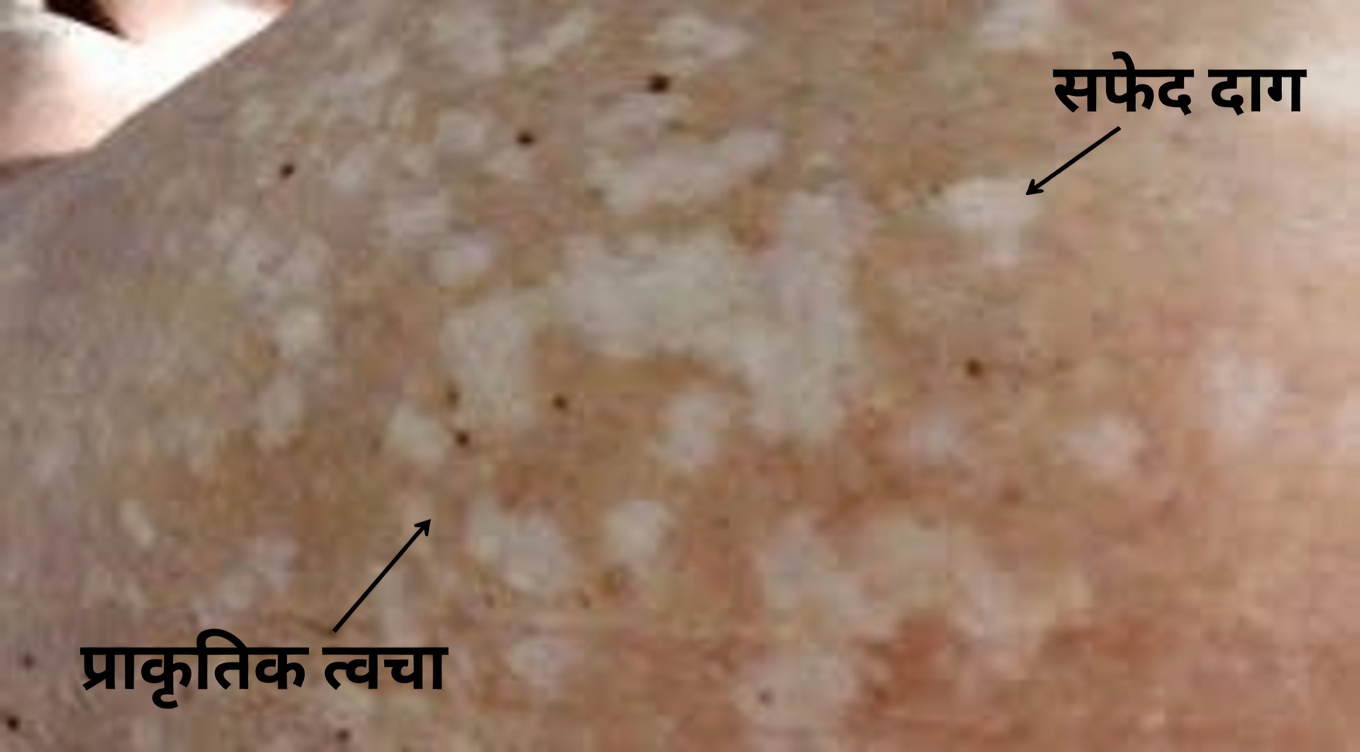 आपकी बाहों, पैरों और पीठ पर ये छोटे सफेद धब्बे: त्वचा में होने वाले इस आम बदलाव के बारे में आपको क्या जानना चाहिए