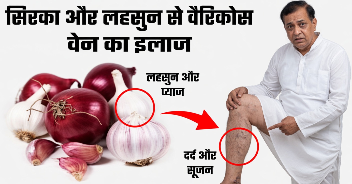 वैरिकाज़ के लिए प्राकृतिक उपाय: रक्त संचार सुधारने के लिए