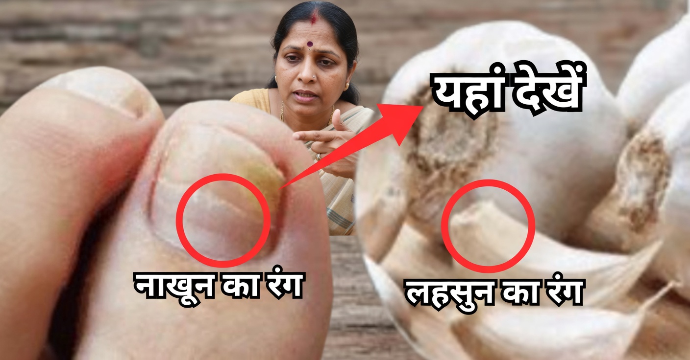 सिर, हाथ, नाखून और पैरों के फंगल इंफेक्शन के लिए लहसुन