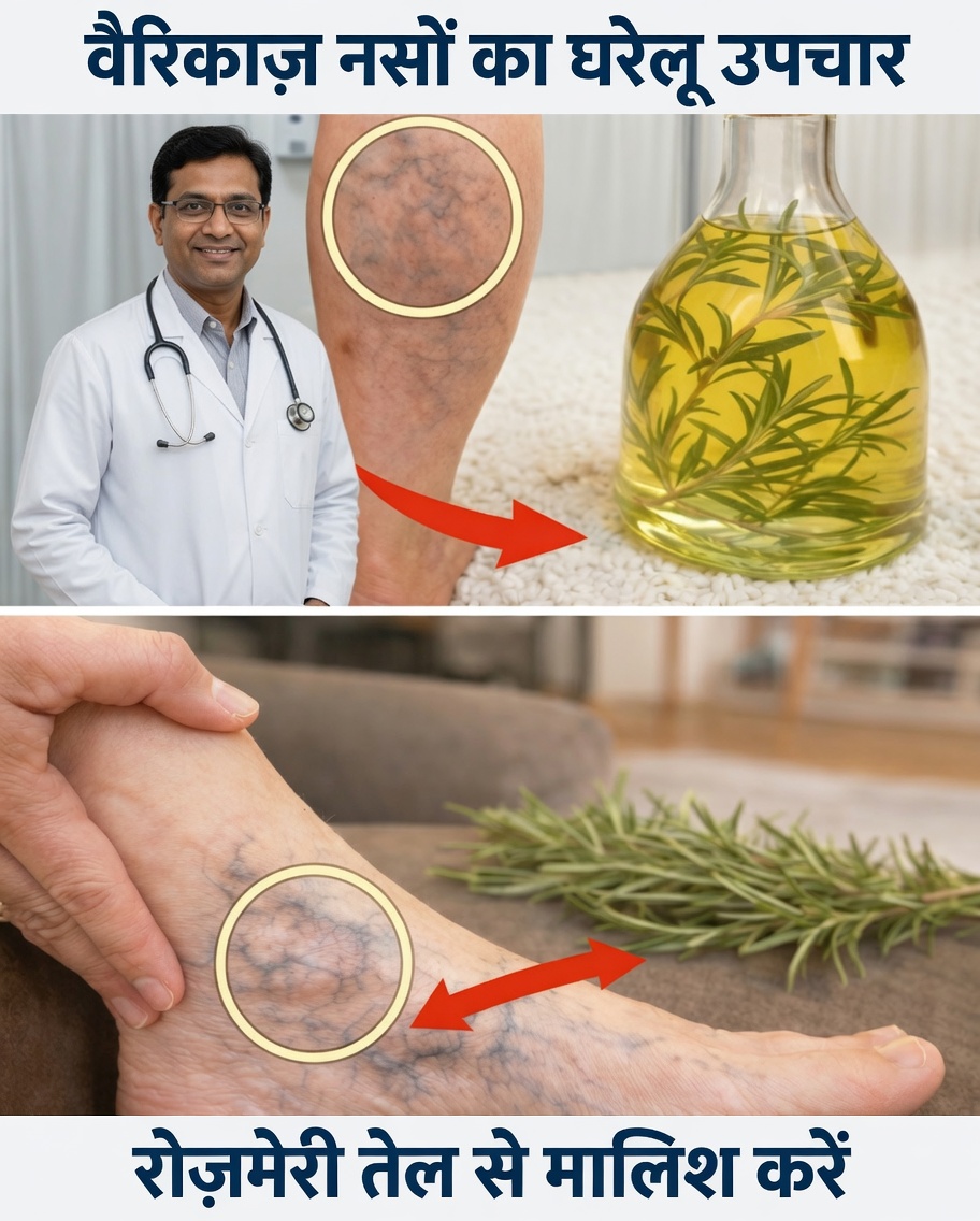 अद्भुत खोज: कैसे रोज़मेरी वैरिकाज़ नसों की सेहत और पैरों के आराम को सहारा दे सकती है