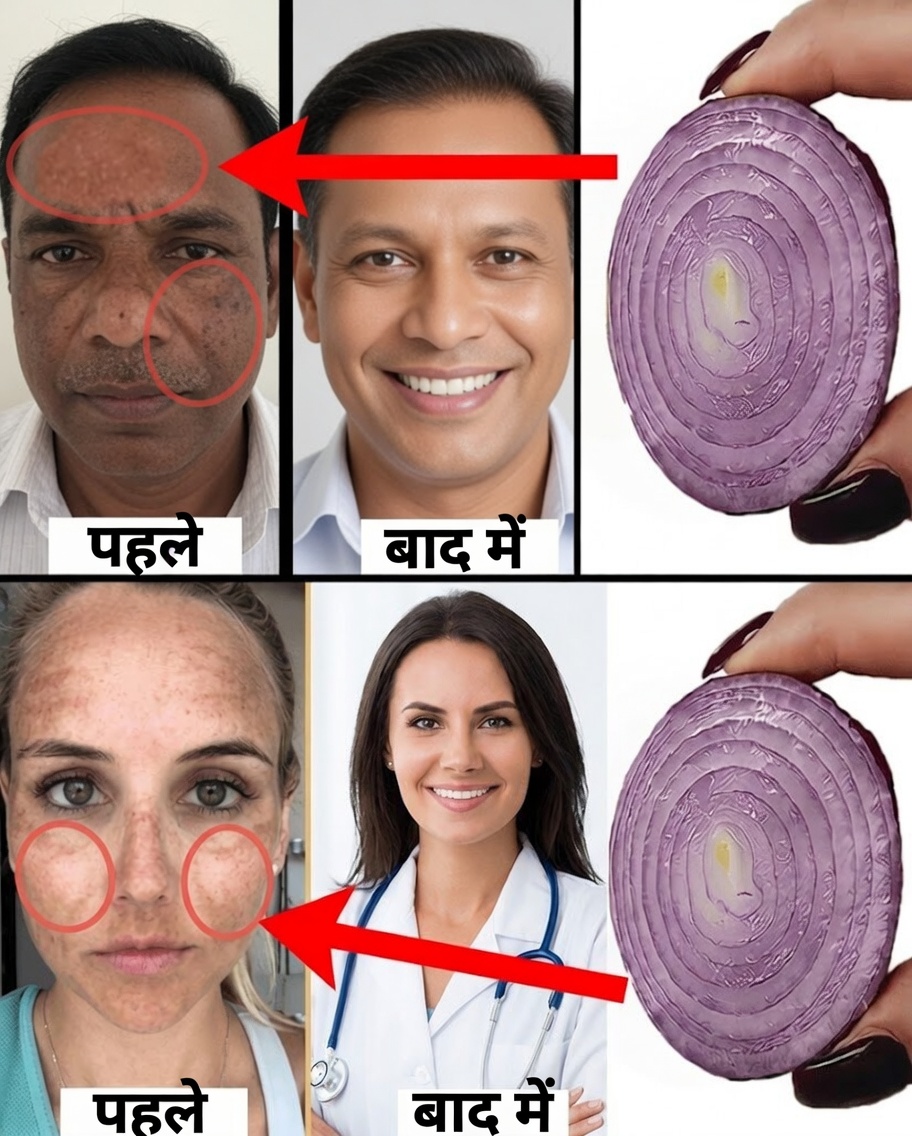 बर्फ जैसी सफेद, कांच जैसी साफ त्वचा के लिए कॉर्नस्टार्च को प्याज के साथ मिलाएँ: एक प्राकृतिक रहस्य जिसे आप काश पहले जान लेते
