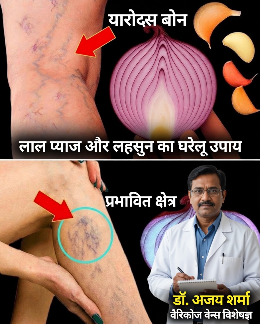 वैरिकाज़ नसों को अलविदा: रसोई का प्राकृतिक रहस्य जो आपके पैरों को बदल सकता है