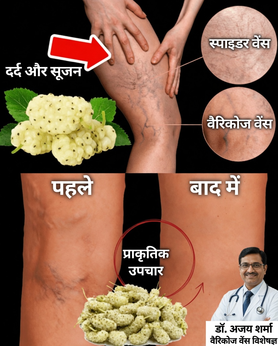 स्वस्थ पैरों के लिए प्राकृतिक मार्ग: वैरिकोज़ नसों से राहत पाने के 15 तरीके
