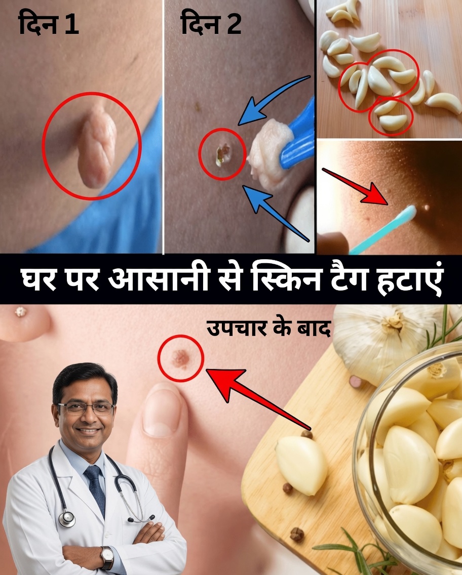वैसलीन से त्वचा के टैग प्राकृतिक रूप से कैसे हटाएँ: एक सरल रातभर का तरीका