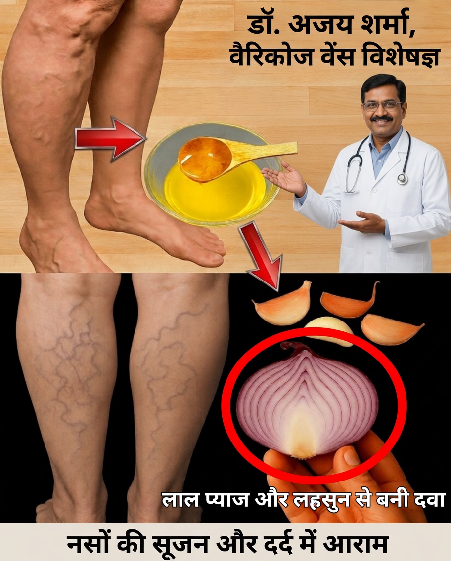 वैरिकाज़ नसों को प्रभावी ढंग से अलविदा कहने के लिए 5 प्राकृतिक रहस्य