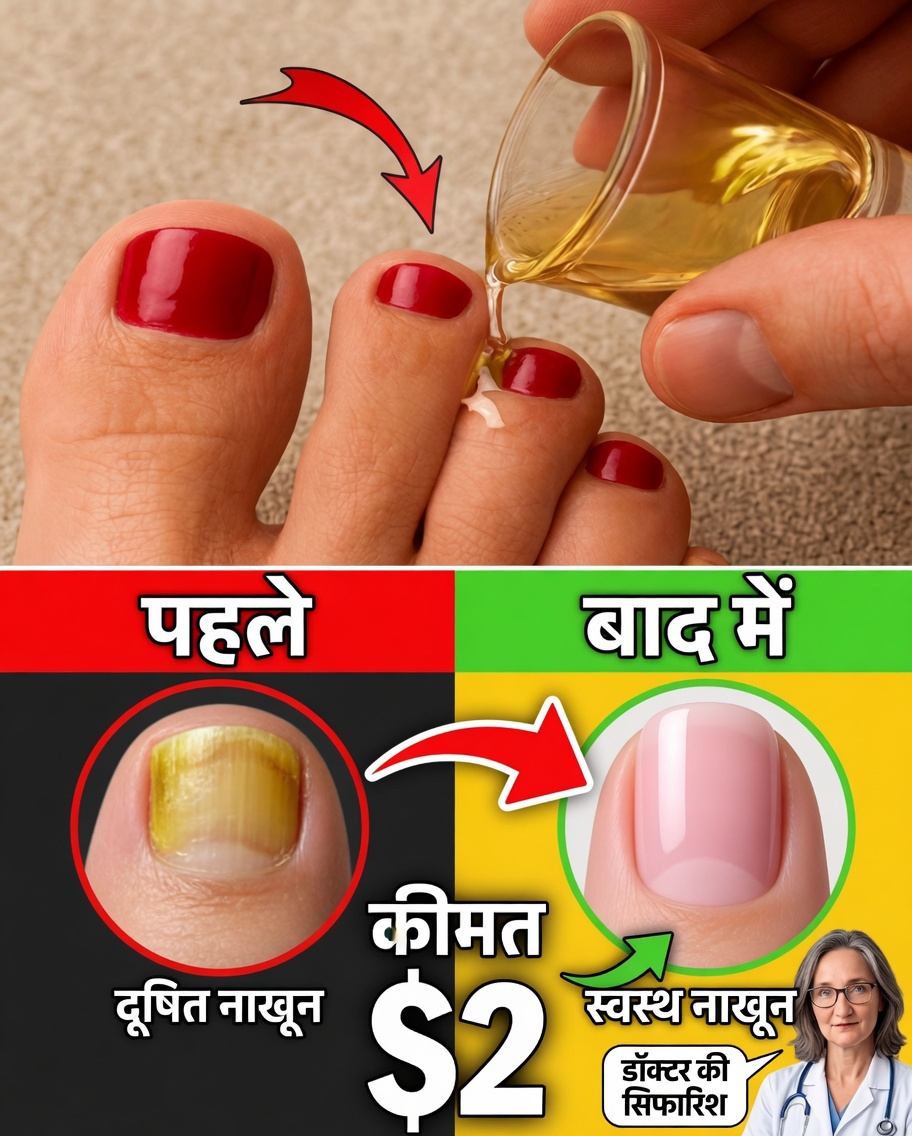 क्या आप नाखून के फंगस से परेशान हैं? यह आसान प्राकृतिक सोक आज़माएँ